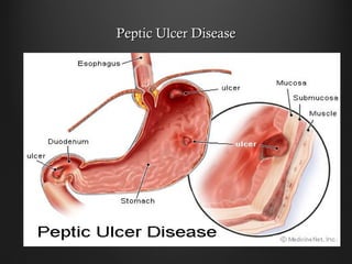 Peptic Ulcer DiseasePeptic Ulcer Disease
 