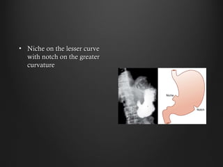 • Niche on the lesser curveNiche on the lesser curve
with notch on the greaterwith notch on the greater
curvaturecurvature
 
