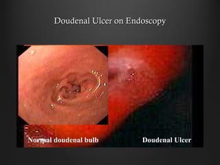 Doudenal Ulcer on EndoscopyDoudenal Ulcer on Endoscopy
Doudenal UlcerNormal doudenal bulb
 