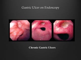 Gastric Ulcer on EndoscopyGastric Ulcer on Endoscopy
Chronic Gastric Ulcers
 