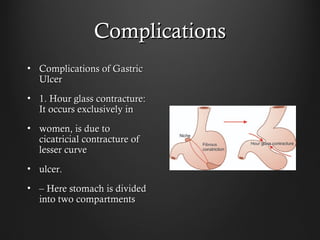 ComplicationsComplications
• Complications of GastricComplications of Gastric
UlcerUlcer
• 1. Hour glass contracture:1. Hour glass contracture:
It occurs exclusively inIt occurs exclusively in
• women, is due towomen, is due to
cicatricial contracture ofcicatricial contracture of
lesser curvelesser curve
• ulcer.ulcer.
• –– Here stomach is dividedHere stomach is divided
into two compartmentsinto two compartments
 