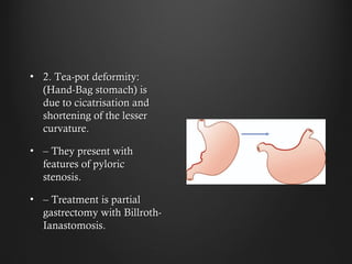 • 2. Tea-pot deformity:2. Tea-pot deformity:
(Hand-Bag stomach) is(Hand-Bag stomach) is
duedue to cicatrisation andto cicatrisation and
shortening of the lessershortening of the lesser
curvature.curvature.
• –– They present withThey present with
features of pyloricfeatures of pyloric
stenosis.stenosis.
• –– Treatment is partialTreatment is partial
gastrectomy with Billroth-gastrectomy with Billroth-
Ianastomosis.Ianastomosis.
 
