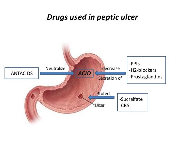 Sucralfate (Carafate) A Pepsin Inhibitor Acts By