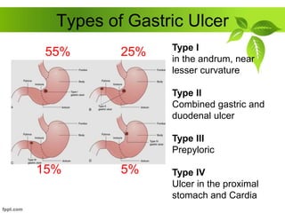 Types of Gastric Ulcer
Type I
in the andrum, near
lesser curvature
Type II
Combined gastric and
duodenal ulcer
Type III
Prepyloric
Type IV
Ulcer in the proximal
stomach and Cardia
55% 25%
15% 5%
 