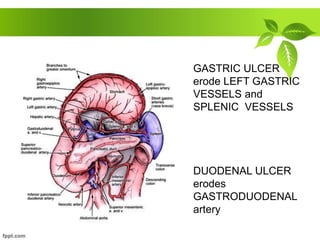 GASTRIC ULCER
erode LEFT GASTRIC
VESSELS and
SPLENIC VESSELS
DUODENAL ULCER
erodes
GASTRODUODENAL
artery
 