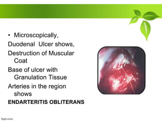 • Microscopically,
Duodenal Ulcer shows,
Destruction of Muscular
Coat
Base of ulcer with
Granulation Tissue
Arteries in the region
shows
ENDARTERITIS OBLITERANS
 