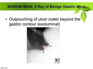 BARIUM MEAL X Ray of Benign Gastric Ulcer
• Outpouching of ulcer crater beyond the
gastric contour (exoluminal)
 