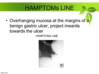 HAMPTOMs LINE
• Overhanging mucosa at the margins of a
benign gastric ulcer, project inwards
towards the ulcer
HAMPTOMs LINE
 