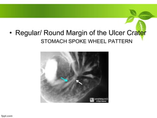 • Regular/ Round Margin of the Ulcer Crater
STOMACH SPOKE WHEEL PATTERN
 
