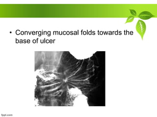 • Converging mucosal folds towards the
base of ulcer
 