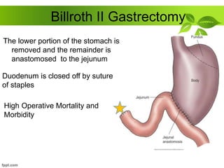 Billroth II Gastrectomy
The lower portion of the stomach is
removed and the remainder is
anastomosed to the jejunum
Duodenum is closed off by suture
of staples
High Operative Mortality and
Morbidity
 