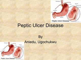 Peptic Ulcer Disease
By
Aniedu, Ugochukwu
 