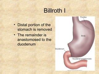 Billroth I
• Distal portion of the
stomach is removed
• The remainder is
anastomosed to the
duodenum
 
