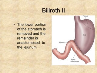 Billroth II
• The lower portion
of the stomach is
removed and the
remainder is
anastomosed to
the jejunum
 
