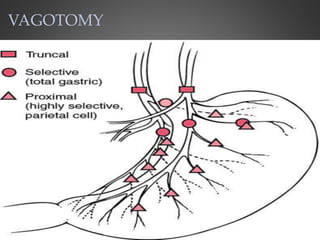 VAGOTOMY
 