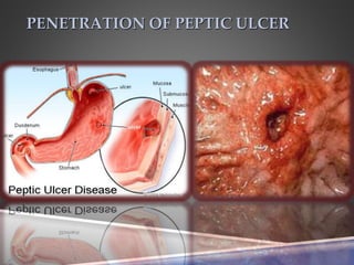 PENETRATION OF PEPTIC ULCER
 