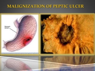 MALIGNIZATION OF PEPTIC ULCER
 