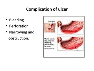 peptic-ulcer-ahn-ppt