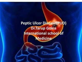 Peptic Ulcer Disease(PUD)
Dr.Tarup Gokia
International school of
Medicine
 
