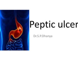 Peptic ulcer
Dr.S.P.Dhanya
 