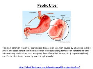 The most common reason for peptic ulcer disease is an infection caused by a bacteria called H
pylori. The second most common reason for the ulcers is long-term use of nonsteroidal anti-
inflammatory medications such as aspirin, ibuprofen (Advil, Motrin, etc.), naproxen (Aleve),
etc. Peptic ulcer is not caused by stress or spicy foods!
Peptic Ulcer
http://sripathikethumd.com/digestive-conditions/peptic-ulcer/
 
