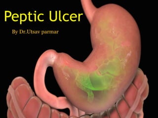 Peptic Ulcer
By Dr.Utsav parmar
 