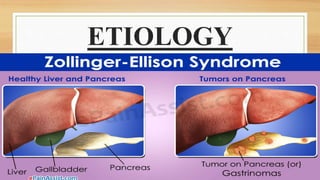 ETIOLOGY
 