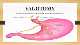 VAGOTOMY
 