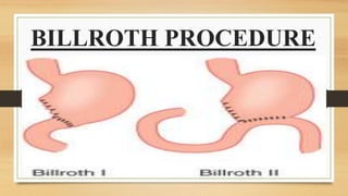 BILLROTH PROCEDURE
 