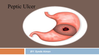 Peptic Ulcer
BY: Syeda Aiman
 