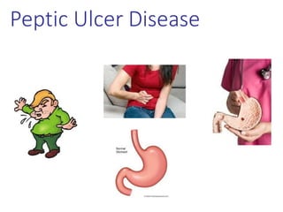 Peptic Ulcer Disease
 