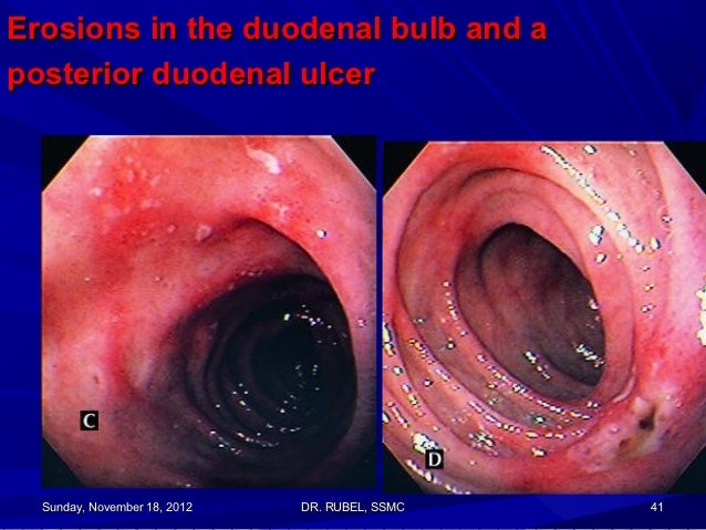 an analysis of the stomach ulcer the symptoms and causes in medical research Stomach cancer, also known as gastric cancer, is a cancer which develops from the lining of the stomach early symptoms may include heartburn, upper abdominal pain, nausea and loss of appetite later signs and symptoms may include weight loss, yellowing of the skin and whites of the eyes, vomiting, difficulty swallowing and blood in the stool among others. an analysis of the stomach ulcer the symptoms and causes in medical research Stomach cancer, also known as gastric cancer, is a cancer which develops from the lining of the stomach early symptoms may include heartburn, upper abdominal pain, nausea and loss of appetite later signs and symptoms may include weight loss, yellowing of the skin and whites of the eyes, vomiting, difficulty swallowing and blood in the stool among others.