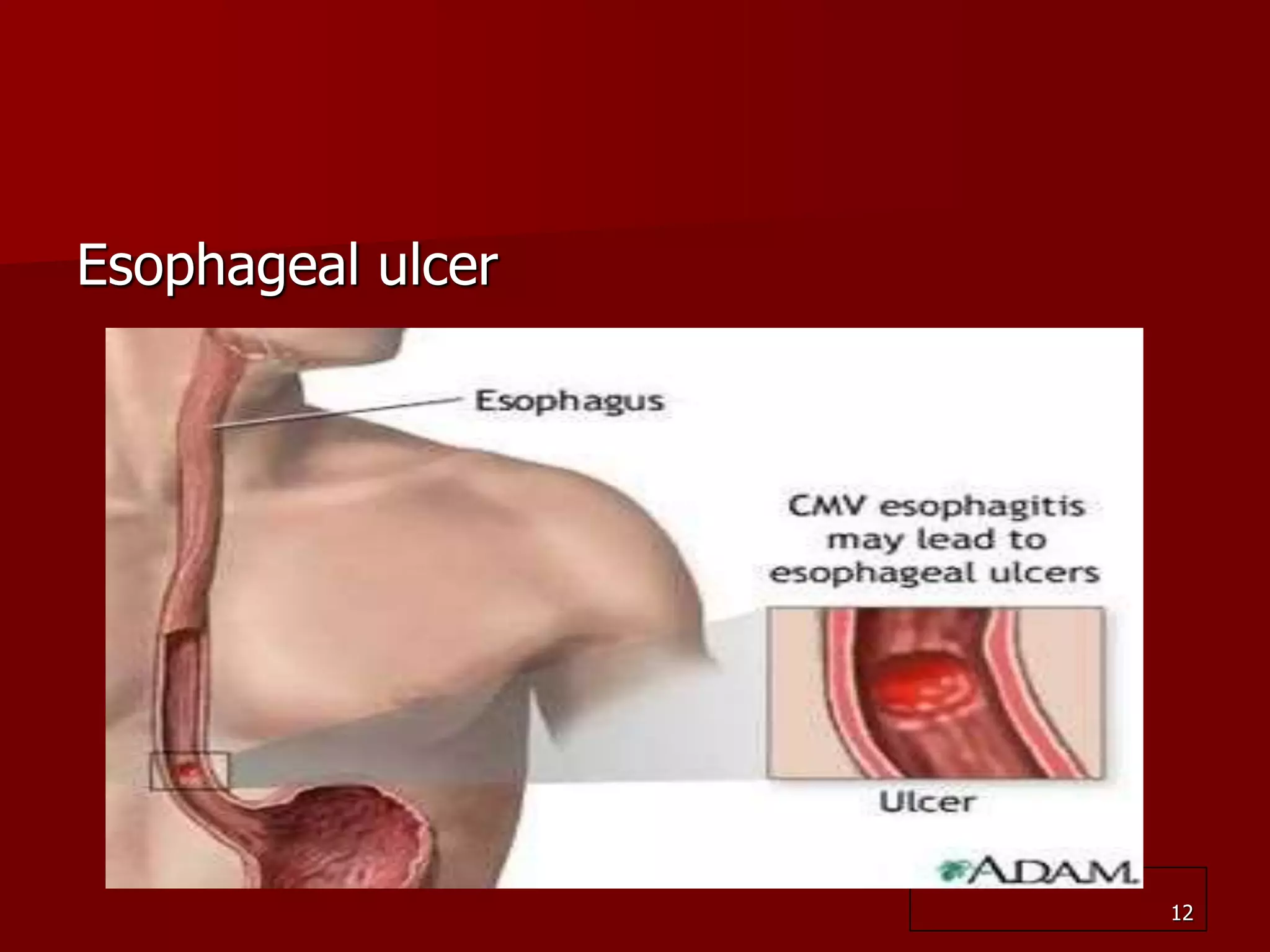 peptic-ulcer-and-duodenal-ulcer-ppt2-ppt