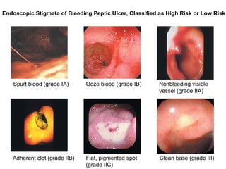 Endoscopic Stigmata of Bleeding Peptic Ulcer, Classified as High Risk or Low Risk Spurt blood (grade IA) Ooze blood (grade IB) Nonbleeding visible vessel (grade IIA) Adherent clot (grade IIB) Flat, pigmented spot (grade IIC) Clean base (grade III) 