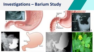 Hampton Line Peptic Ulcer Disease + Carcinoma Stomach. | PDF