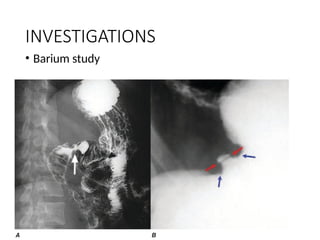 Hampton Line Peptic Ulcer Disease- basics to management.pptx