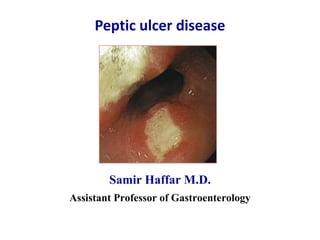 Peptic ulcer disease
Samir Haffar M.D.
Assistant Professor of Gastroenterology
 