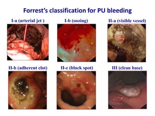 Peptic ulcer disease | PPTX
