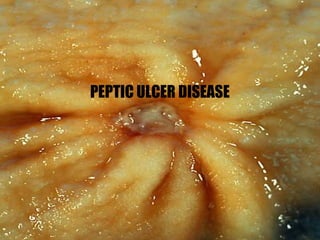 PEPTIC ULCER DISEASE
 