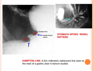 Hampton Line Peptic ulcer disease | PPTX