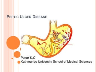 PEPTIC ULCER DISEASE
Pukar K.C
Kathmandu University School of Medical Sciences
 