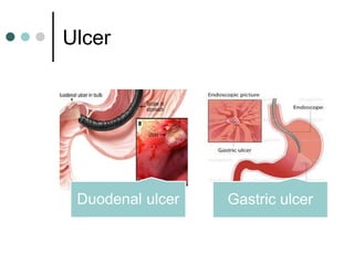 Ulcer
Duodenal ulcer Gastric ulcer
 