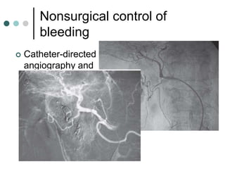 Nonsurgical control of
bleeding
 Catheter-directed
angiography and
endovascular
embolization
 