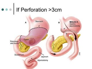 If Perforation >3cm
 