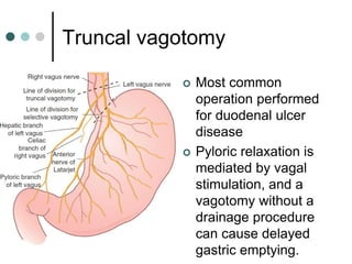 Truncal vagotomy
 Most common
operation performed
for duodenal ulcer
disease
 Pyloric relaxation is
mediated by vagal
stimulation, and a
vagotomy without a
drainage procedure
can cause delayed
gastric emptying.
 