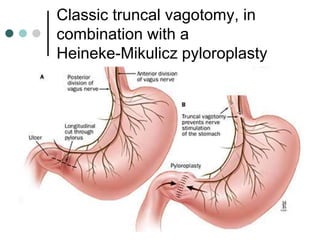 Classic truncal vagotomy, in
combination with a
Heineke-Mikulicz pyloroplasty
 