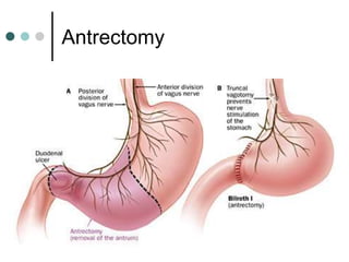 Antrectomy
 