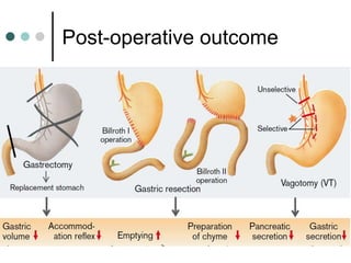 Post-operative outcome
 