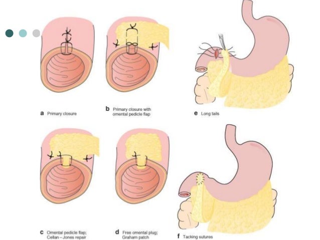 Graham's Patch Peptic ulcer disease