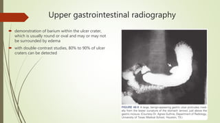 Hampton Line Peptic ulcer disease | PPTX